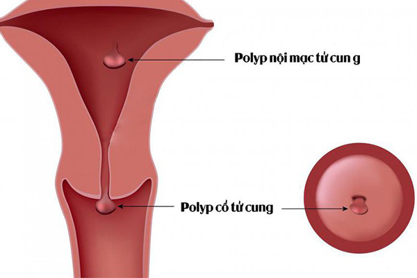 Polyp tử cung khi mang thai